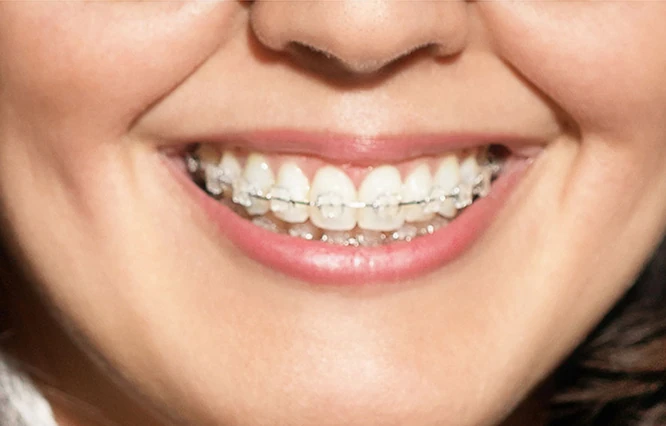 Close-up einer Person mit Keramik-Brackets auf den oberen Zähnen.