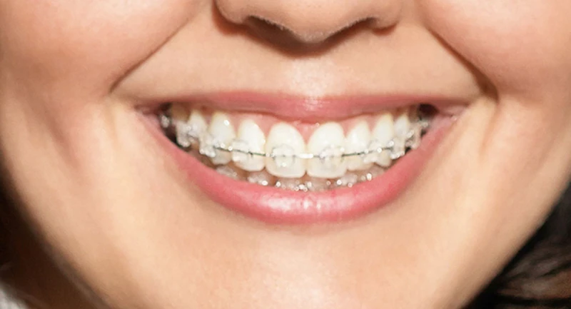 Close up einer Person mit Keramikbrackets auf der oberen Zahnreihe.