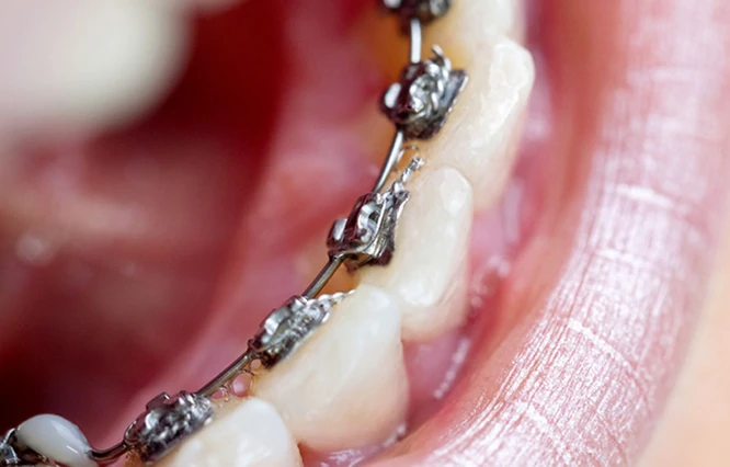 Nahaufnahme von Zähnen mit Metallbrackets, die auf der Innenseite der unteren Zähne befestigt sind.