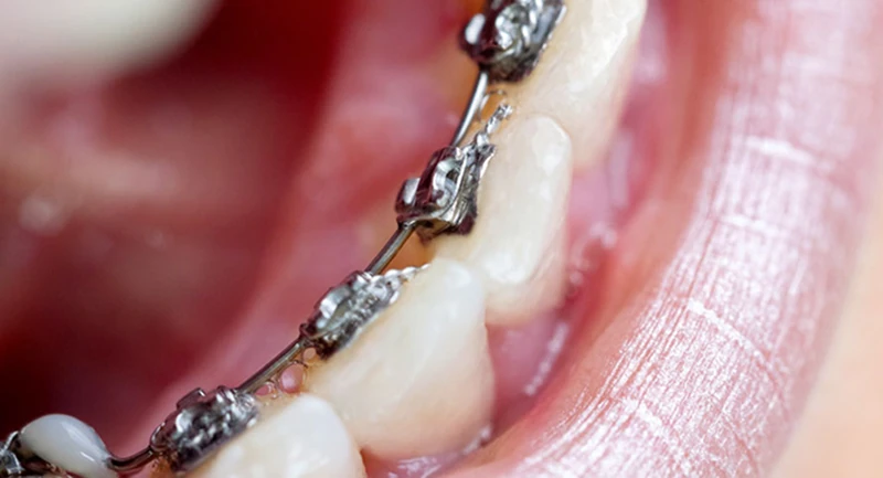 Close up einer Person mit Metallbrackets auf der Innenseite der Zähne.